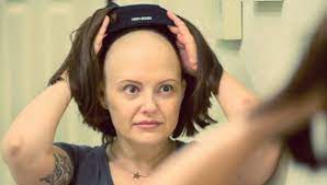Hair loss with chemotherapy